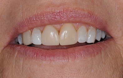 Yellow front teeth before dental veneers