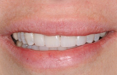 Smile flaws corrected with dental veneers
