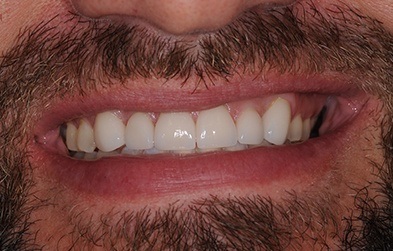 Smile after braces treatment and receiving dental veneers