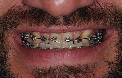 Teeth with braces and yellowing and dental damage