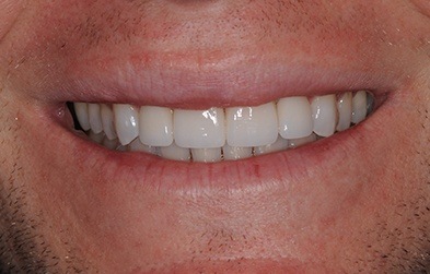 Gorgeous smile after dental crown restoratin