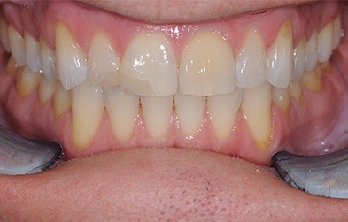 Damaged and discolored teeth before dental crown restoration