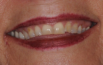 Yellow and worn teeth before full mouth restoration