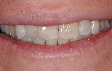 Patient with perfected smile after cosmetic dental bonding