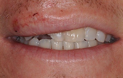 Patient with broken tooth before cosmetic dental bonding