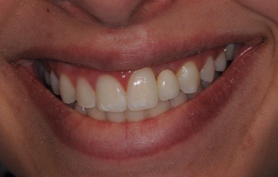 Smile after single tooth dental implant restoration