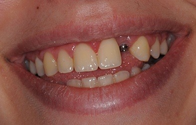 Smile with missing tooth and dental implant post visible