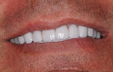 Flawless smile after dental veneer treatment