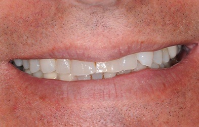 Worn and chipped front teeth before dental veneer treatment
