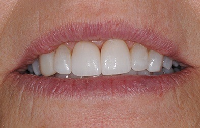 Perfected front teeth before dental veneers