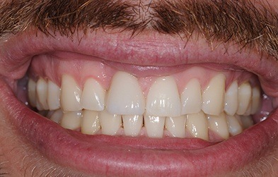 Man with seamlessly replaced front tooth after single tooth dental implant placement