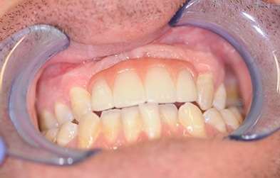 Smile restored after tooth loss with a dental implant retained fixed bridge