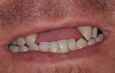 Missing row of top front teeth