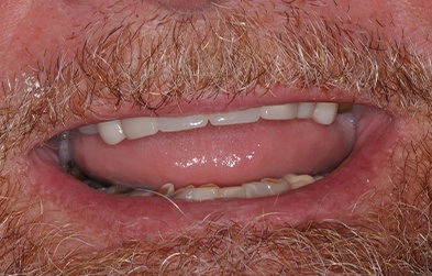 Worn denture