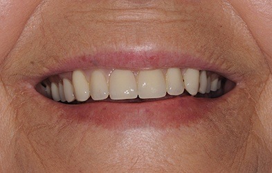 Yellowed smile before new dental implant retained denture