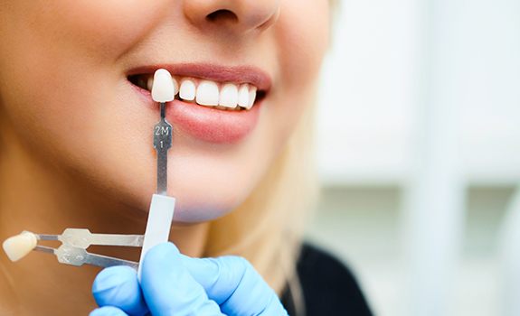 Woman's smile compared with porcelain veneer shade chart