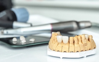 a model of a mouth with porcelain veneers being placed onto the teeth