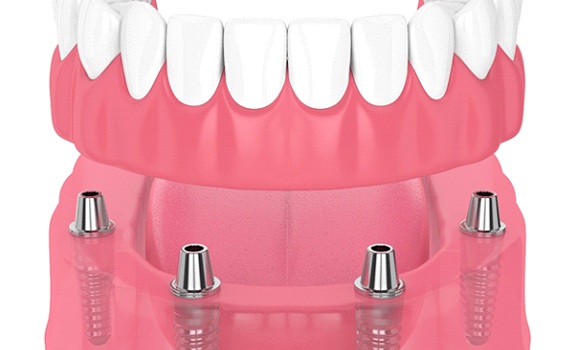 3D model of an implant denture