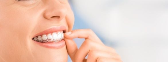 Invisalign special coupon