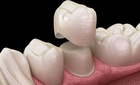 model of a dental crown being placed over a tooth 