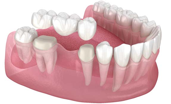 Diagram of a traditional dental bridge in Lakewood Dallas