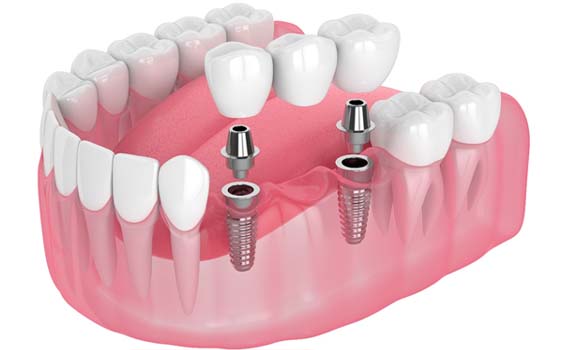 Diagram showing implant bridge in Lakewood Dallas