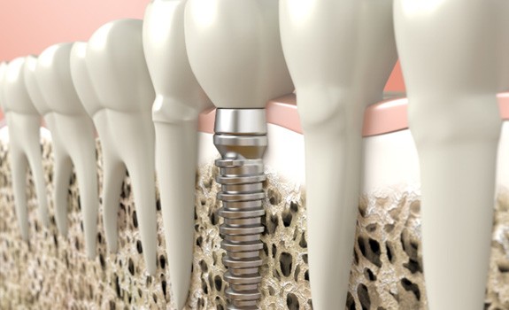 Digital illustration of dental implant