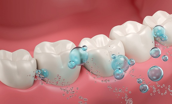 Illustration of fluoride