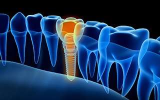 Diagram showing a highlighting and integrated dental implant in Lakewood.