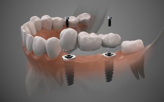 Diagram of dental restorations attaching to dental implants in Lakewood.
