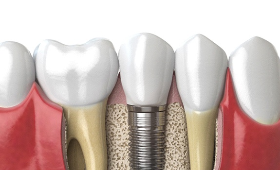 Dental implants in Dallas, TX after surgery