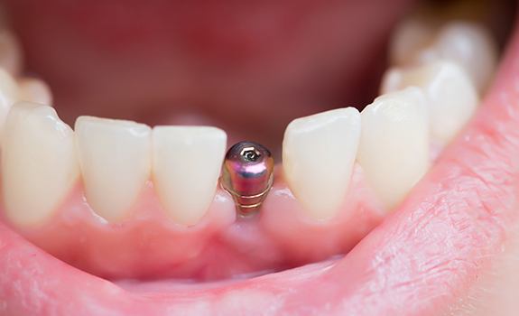 Smile with dental implant post visible