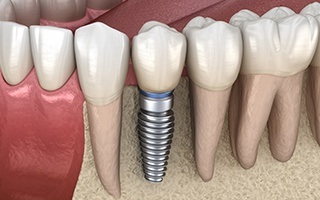 Animated dental implant supported dental crown