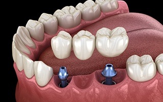 Animated dental implant supported fixed bridge