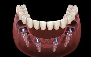 Animated dental implant supported denture