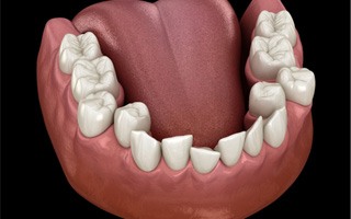 Illustration of crowded teeth