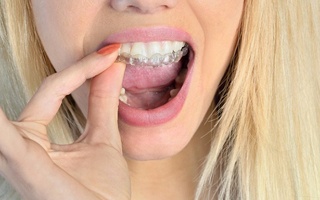 girl putting Invisalign aligner in her mouth