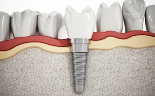 an illustration of a dental implant during osseointegration