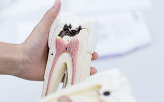 teeth models representing the cost of root canal in Dallas
