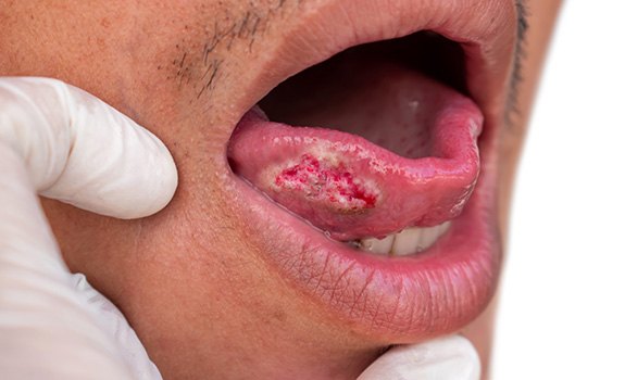Signs and symptoms of oral cancer include sores in the mouth