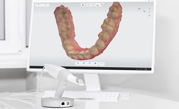 Digital bite impression on chairside computer