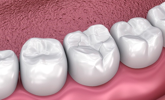 Digital illustration of tooth-colored fillings in Dallas