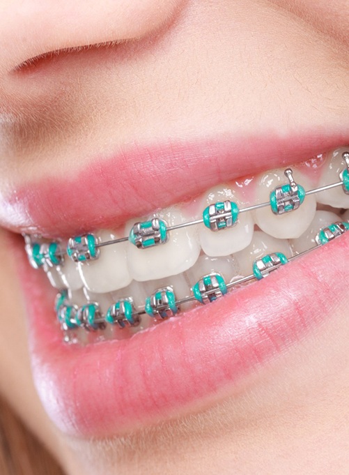 Closeup of someone with braces