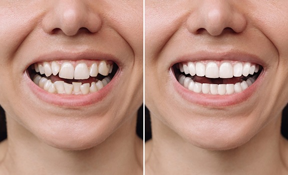 Before and after of braces treatment