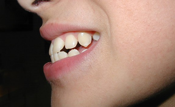 Closeup of an underbite