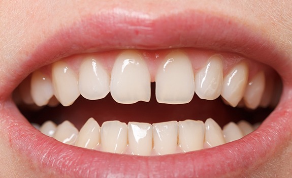 Woman with braces holding a toothbrush and floss