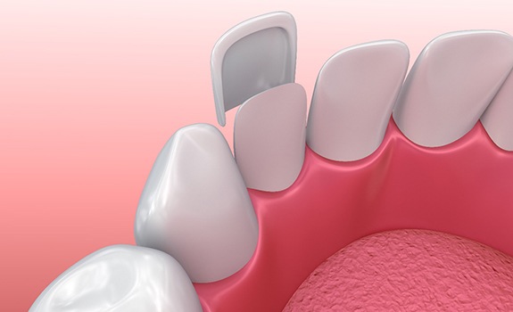 Diagram of veneers in Lakewood