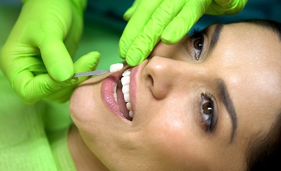 Lakewood cosmetic dentist applying veneers in Lakewood