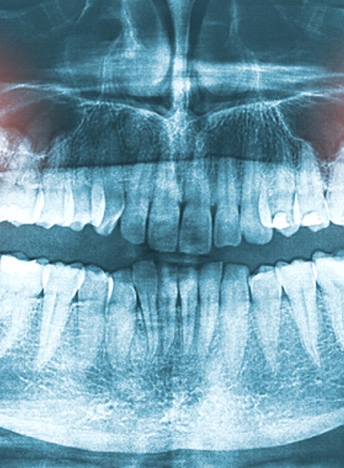 an X-ray showing two wisdom teeth on the upper arch of teeth