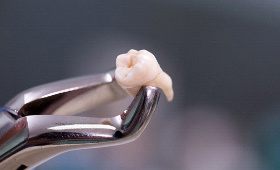 dental forceps holding a wisdom tooth